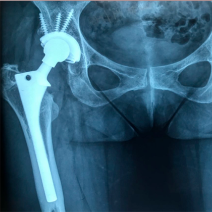 QUAIS SO OS TIPOS DE CIRURGIA DO QUADRIL?